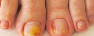 The basic symptoms and photos of onychomycosis