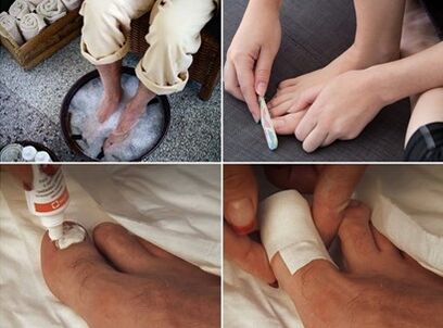 Soothing feet and applying urea cream to nails affected by fungus