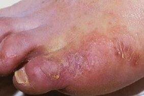 Manifestations of a fungal infection on the skin of the legs
