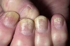 Nail changes with fungal infection