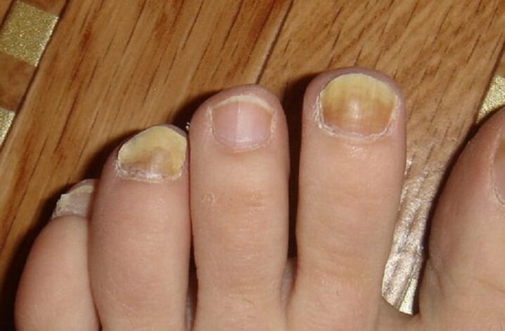 Symptoms of fungi on the nails and skin of the feet