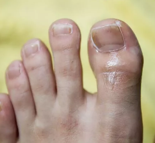 Nail fungus on the big toe