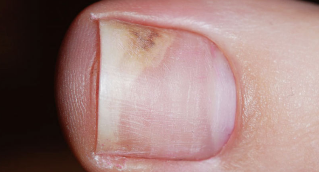 Symptoms of the initial phase of the onychomycosis