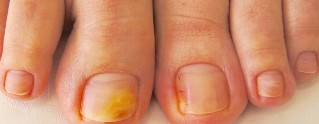 Nail fungus on feet symptoms