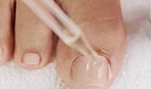 Drop of nail fungus on the feet