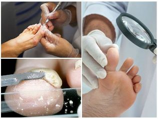 Fungus of the skin of the foot diagnosis
