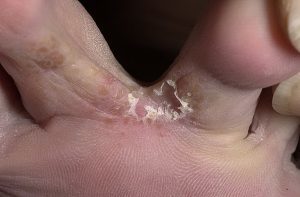 The Form of fungal foot