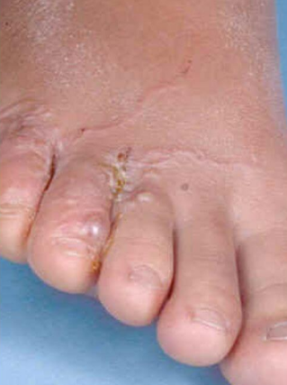 The fungus between the toes